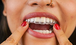 closeup of a woman putting in your Invisalign trays