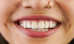 closeup of a person wearing Invisalign