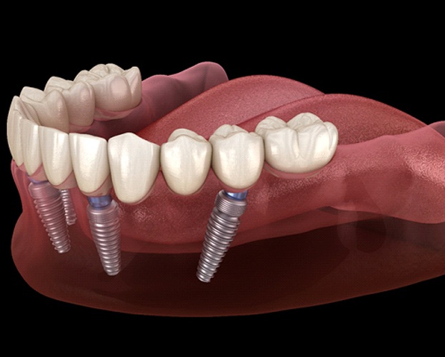 Illustration of All On 4 dental implants in West Seneca replacing lower arch of teeth