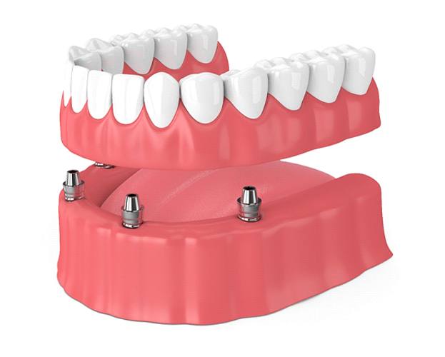 Illustration of an implant denture being placed
