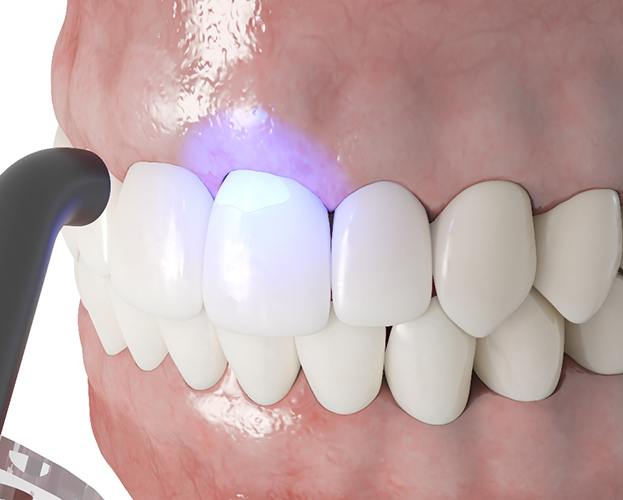 illustration of curing dental bonding