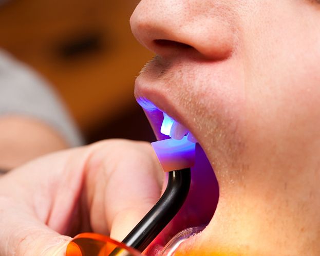 closeup of a patient being treated with cosmetic dental bonding