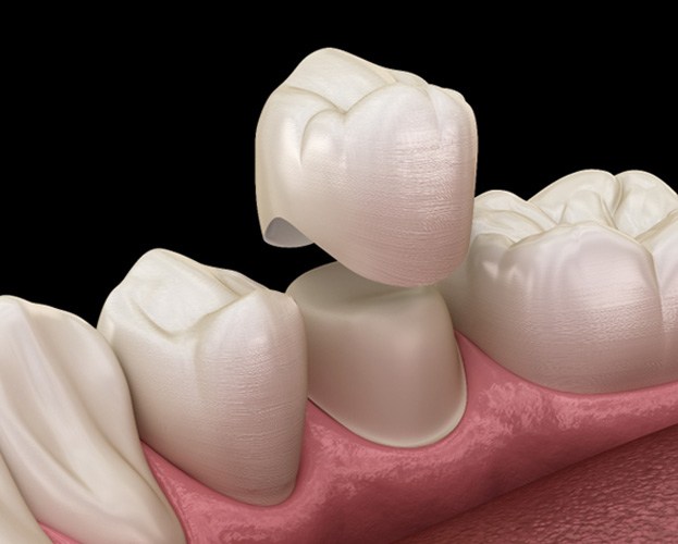 Illustrated dental crown in West Seneca being fitted over a tooth