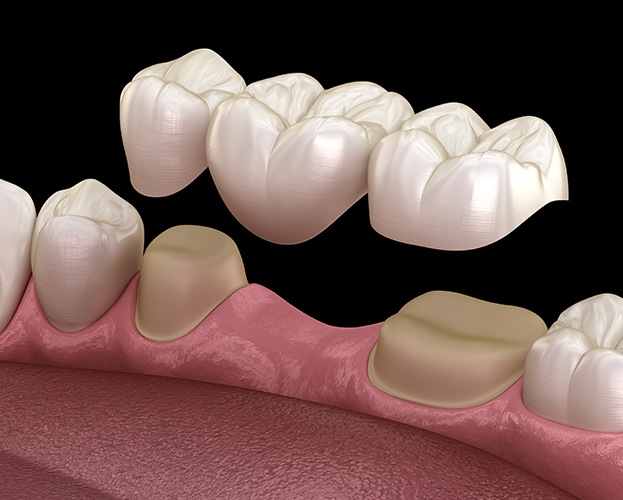 Animated dental crown supported fixed bridge placement
