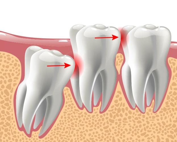Animated smile with impacted wisdom tooth
