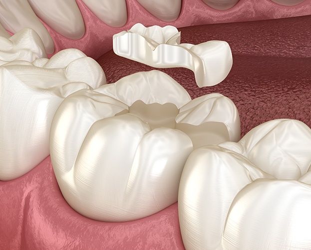 Animated smile during tooth colored filling placement