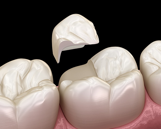 Animated smile with onlay restoration