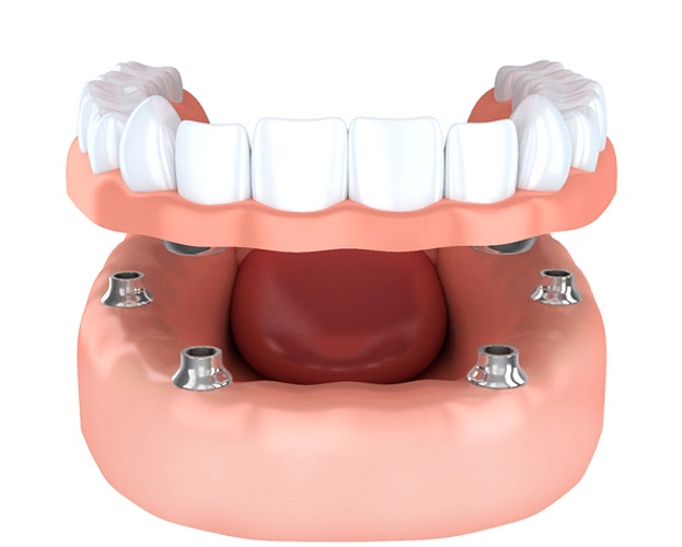 diagram of implant dentures in West Seneca