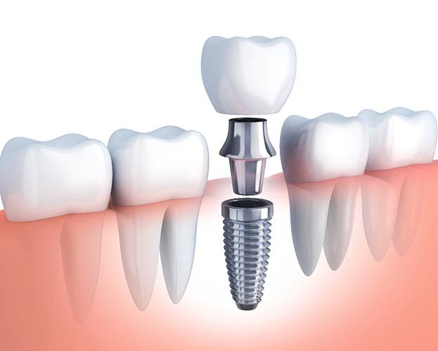 Illustration of a dental implant with a crown being placed in the lower jaw