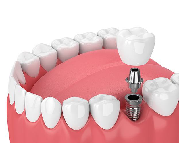 diagram of a single tooth dental implant in West Seneca
