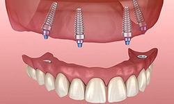 Diagram of implant dentures in West Seneca