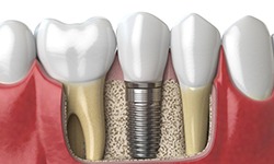 diagram of dental implants in West Seneca