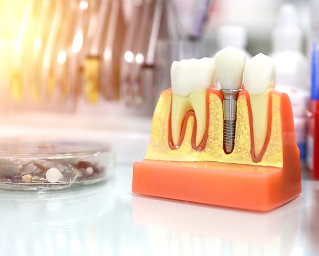 model of dental implants on a desk