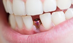 Closeup of dental implants in West Seneca after placement
