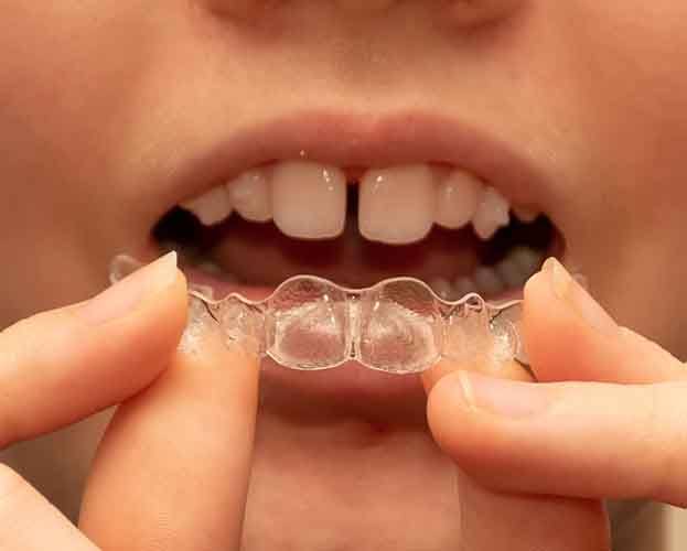 close up of a woman putting Invisalign aligners in her mouth