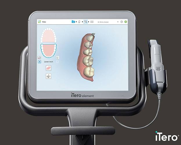 iTero digital smile impression on computer screen