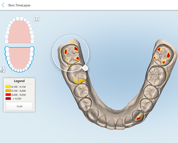 Digital impressions used to create precisely fitted restoration