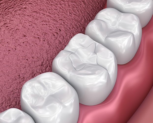 Animated tooth with metal free dental restoration