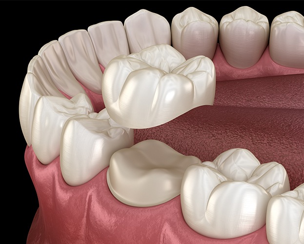 Animated metal free dental crown placement