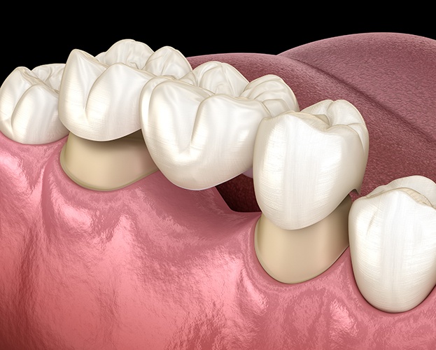 Animated dental bridge being fitted to replace a missing tooth