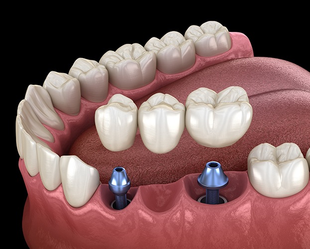 Animated dental implant supporting a fixed bridge