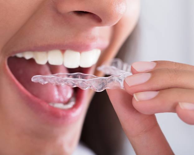 Patient placing an Invisalign clear braces tray over their teeth