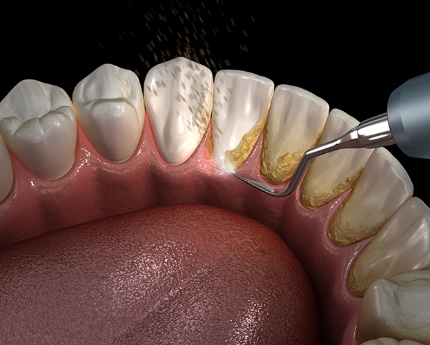 Animated scaler removing plaque buildup from gumline during gum disease treatment