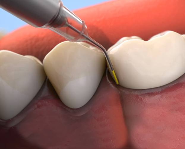 Animated topical antibiotic being applied to the gumline