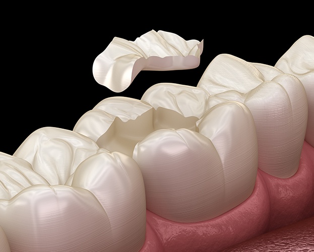 Animated smile before tooth colored filling placement