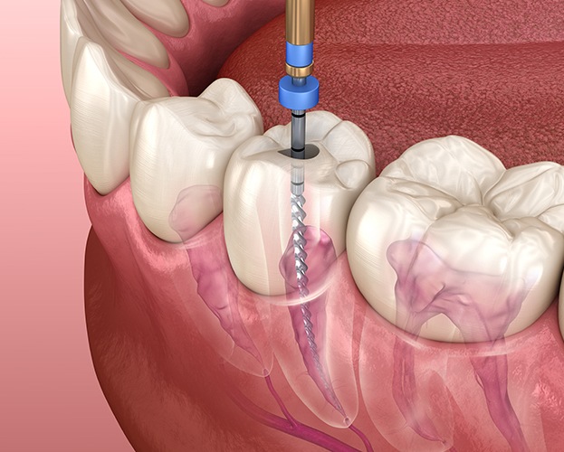 Animated root canal therapy process