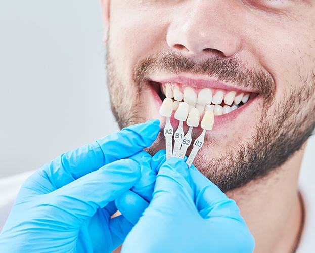 Man's smile compared with porcelain veneer shades