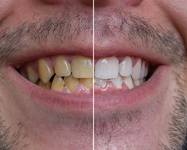 Man looking at smile after in office teeth whitening