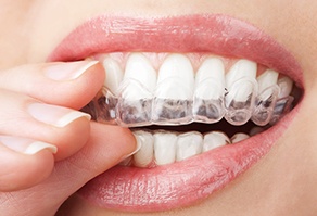 closeup of whitening tray being put in a person’s mouth