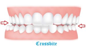 crossbite