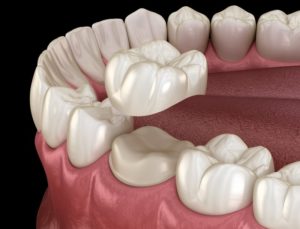 illustration of a prepared tooth getting a crown