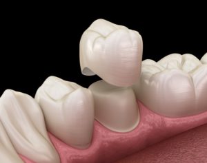 extreme closeup on a dental crown with a dark background